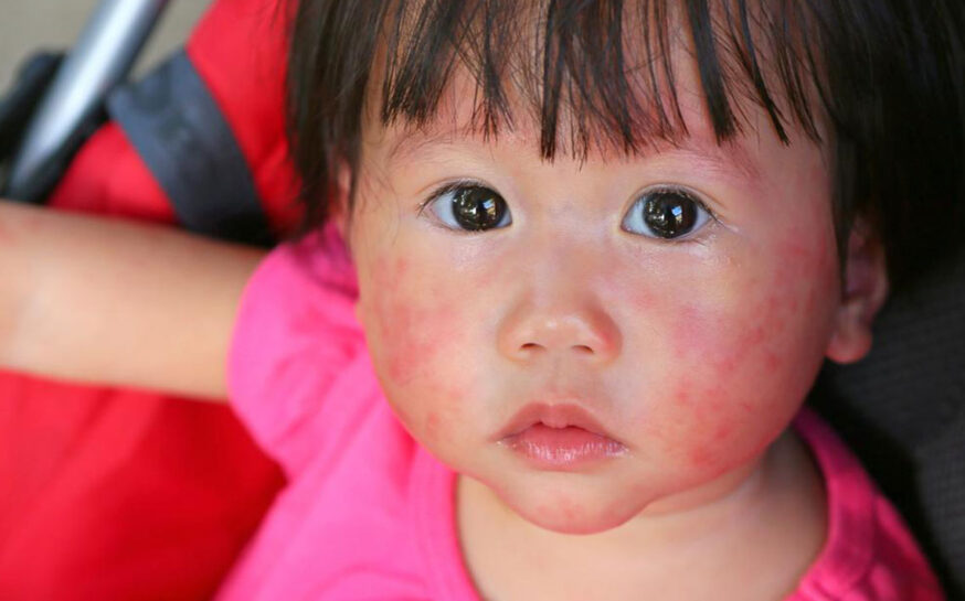 4 useful tips to treatment of atopic dermatitis in children