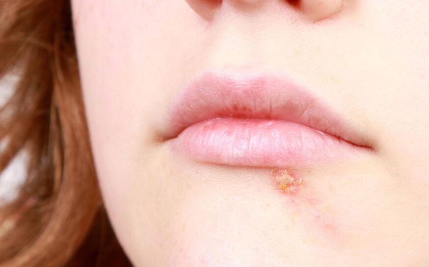 5 useful home remedies to get relief from cold sores