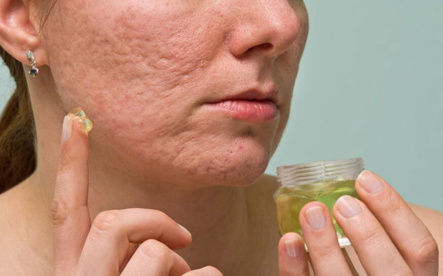 6 useful tips to treat acne scars, marks, and blemishes