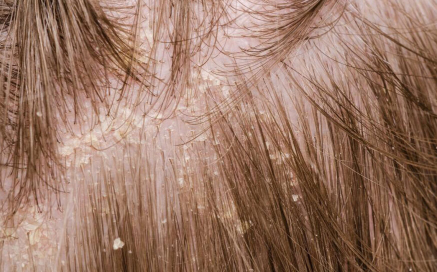 A brief overview of scalp psoriasis