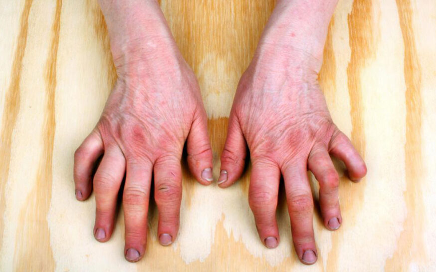Do you have psoriatic arthritis symptoms