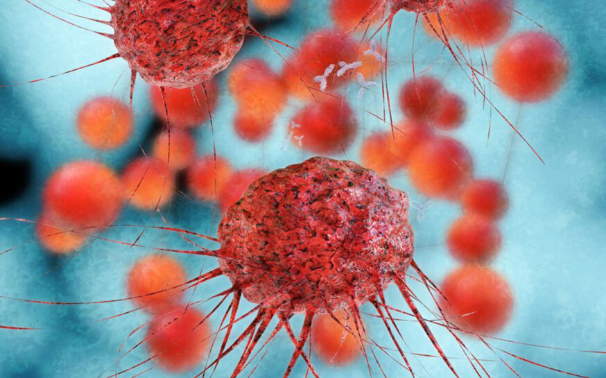 Everything you need to know about metastatic ovarian cancer