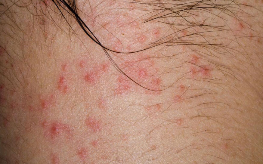 Here are a few common causes of atopic dermatitis