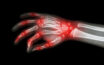 Rheumatoid arthritis and lupus – what makes them similar?