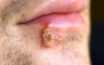 Signs that tell you might have herpes