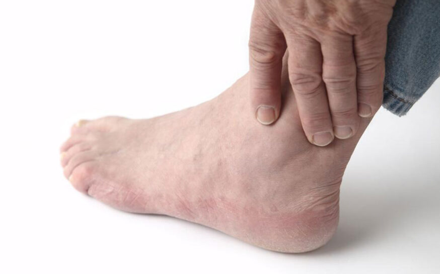 Top Causes of Swollen Ankles