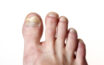 Top signs of toe nail fungus