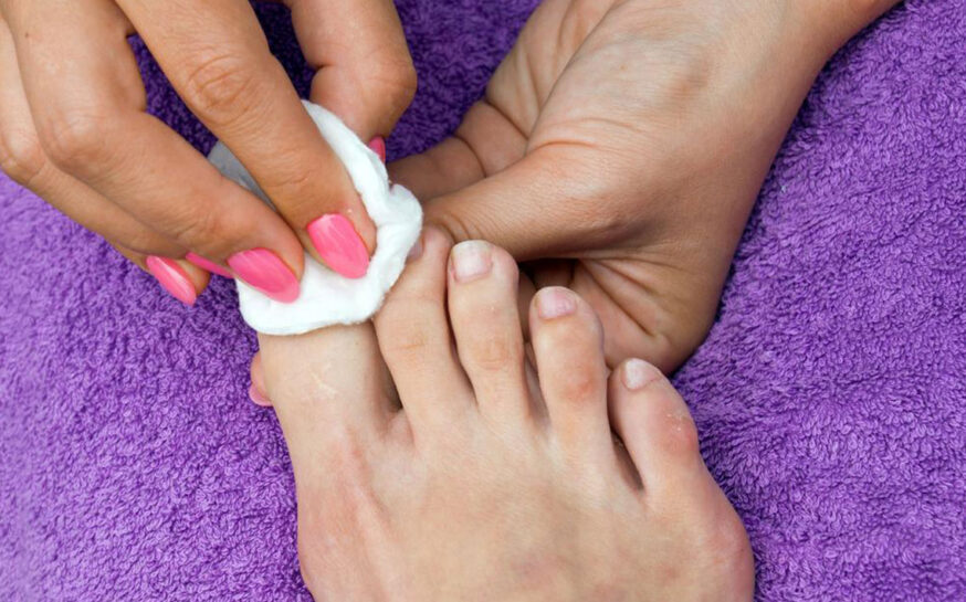 Ways to Cure Nail Fungus