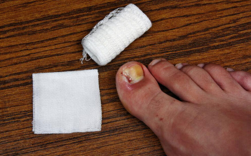 Ways to Treat Toe Nail Fungus During Pregnancy